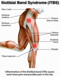 Iliotibial Band Syndrome Treatment